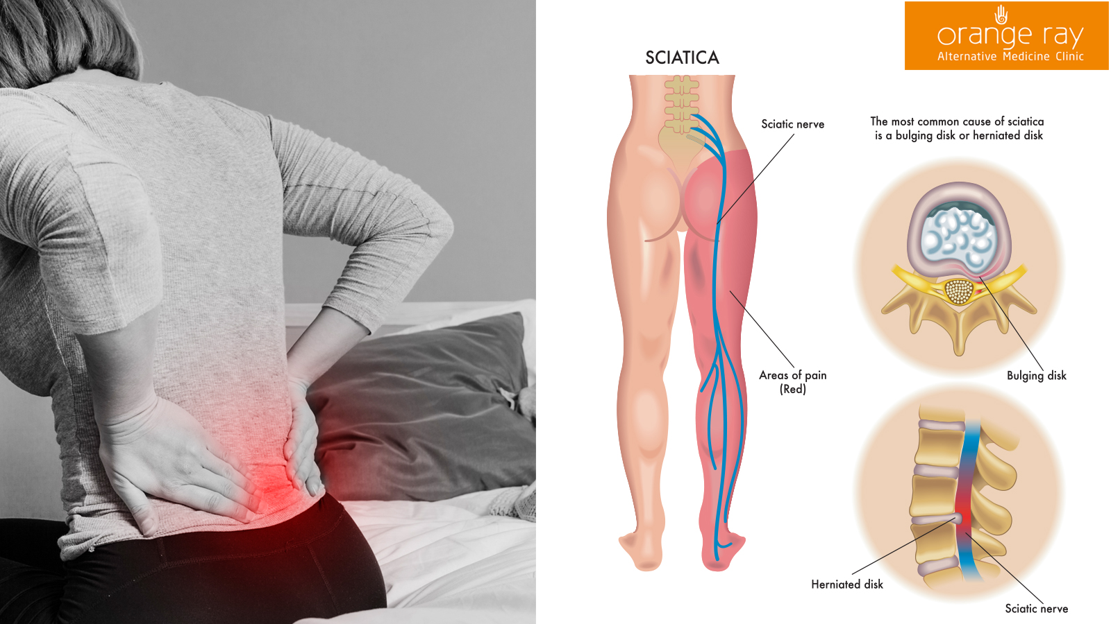 What Is The Best Treatment For Sciatica?